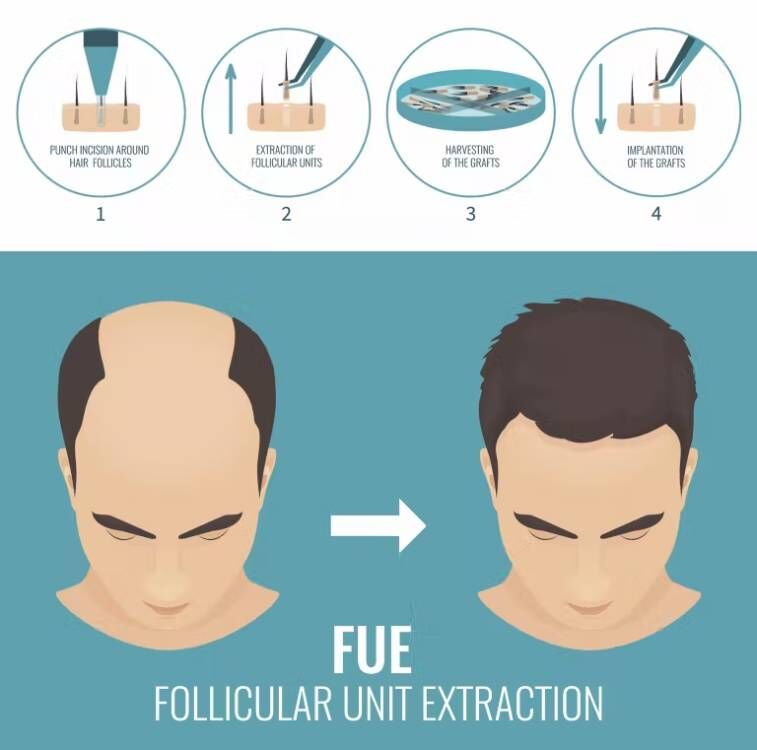 FUE-Machine à Micro Moteur pou - Hair Care Vegan avis et prix